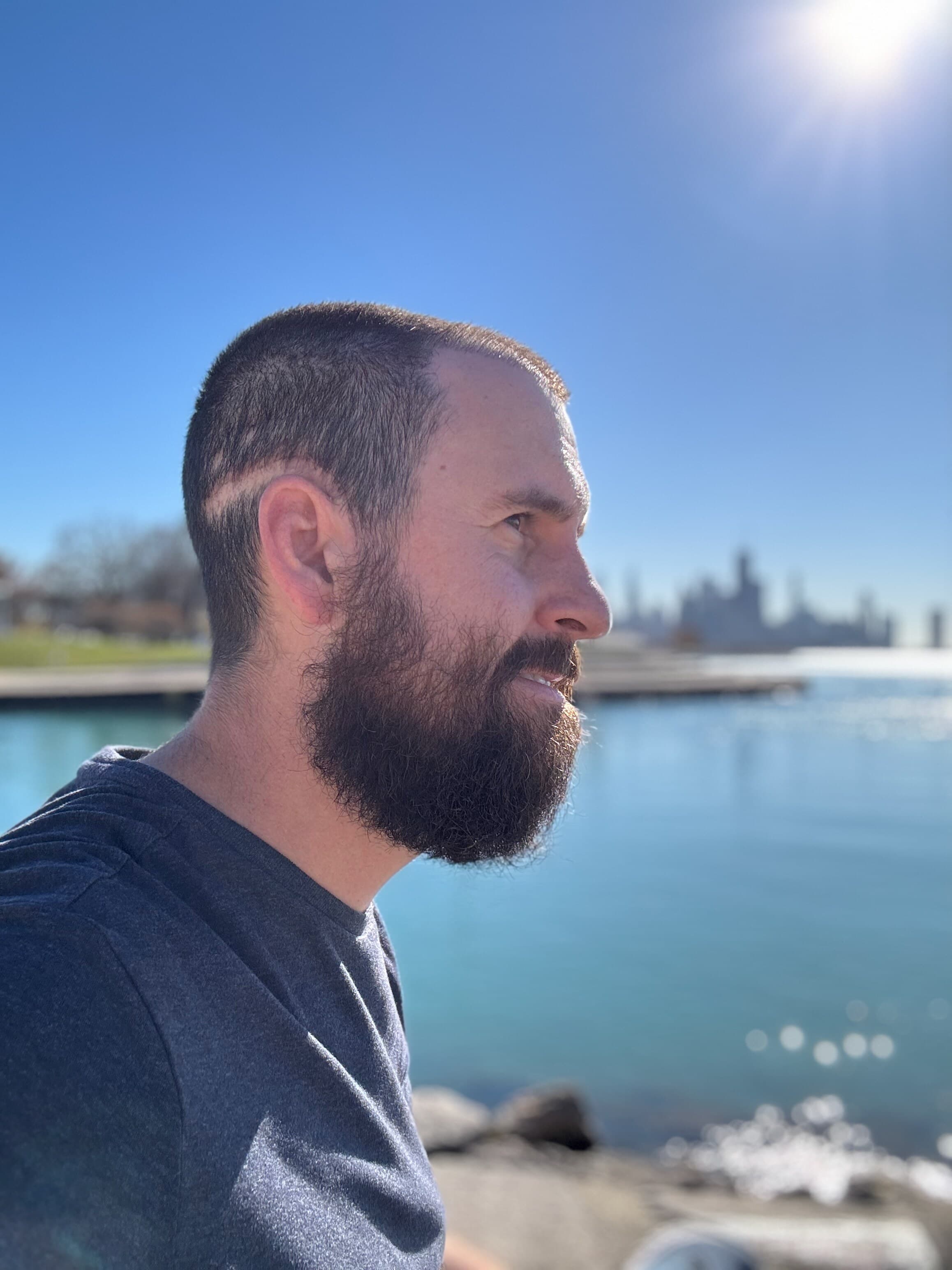 Andrew in profile beside Lake Michigan with the Chicago skyline in the distance, the surgery scar visible across the left side of his head